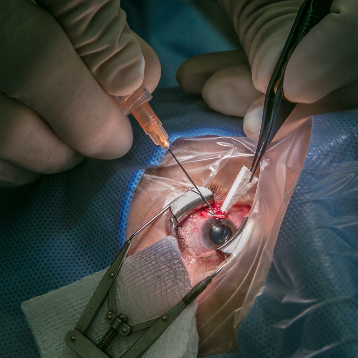 Chirurgia Del Glaucoma