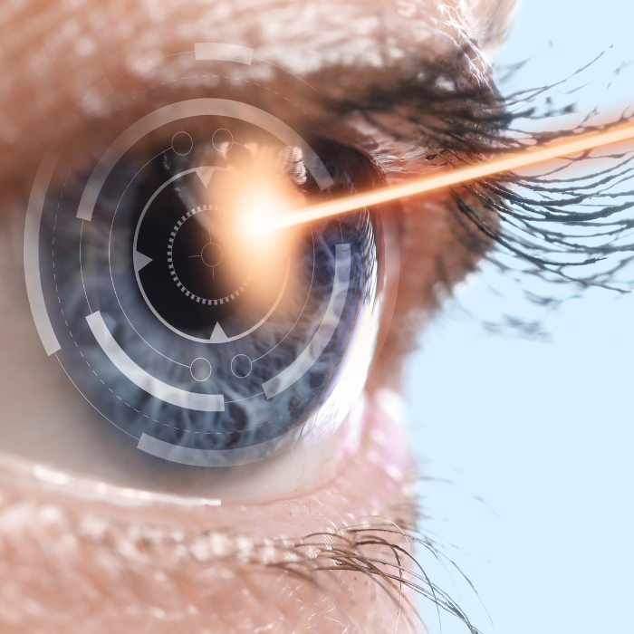 Laser Terapia Selettiva Glaucoma