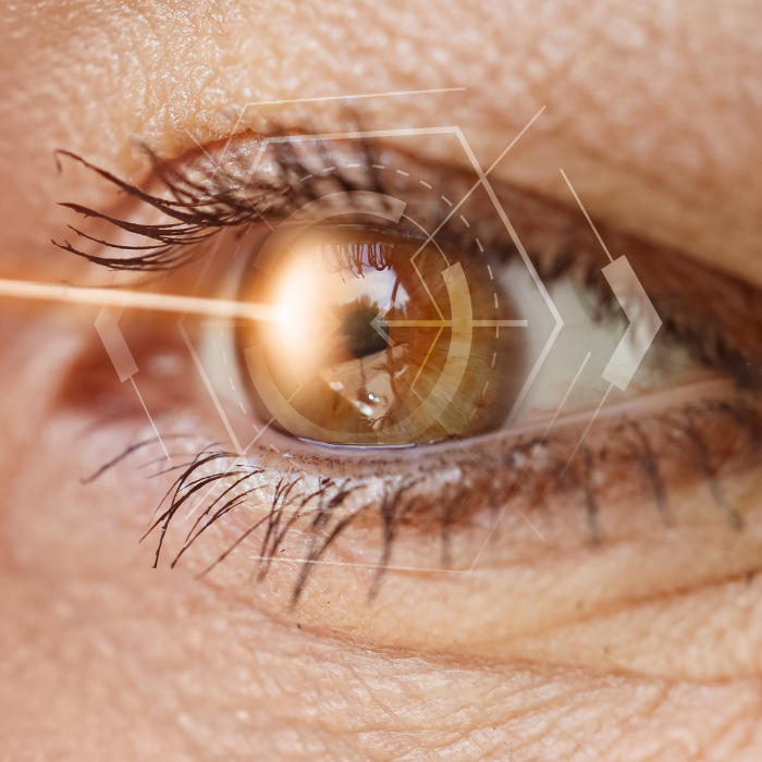 Laser Terapia Selettiva Glaucoma