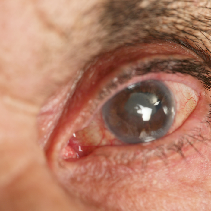 Chirurgia Del Glaucoma