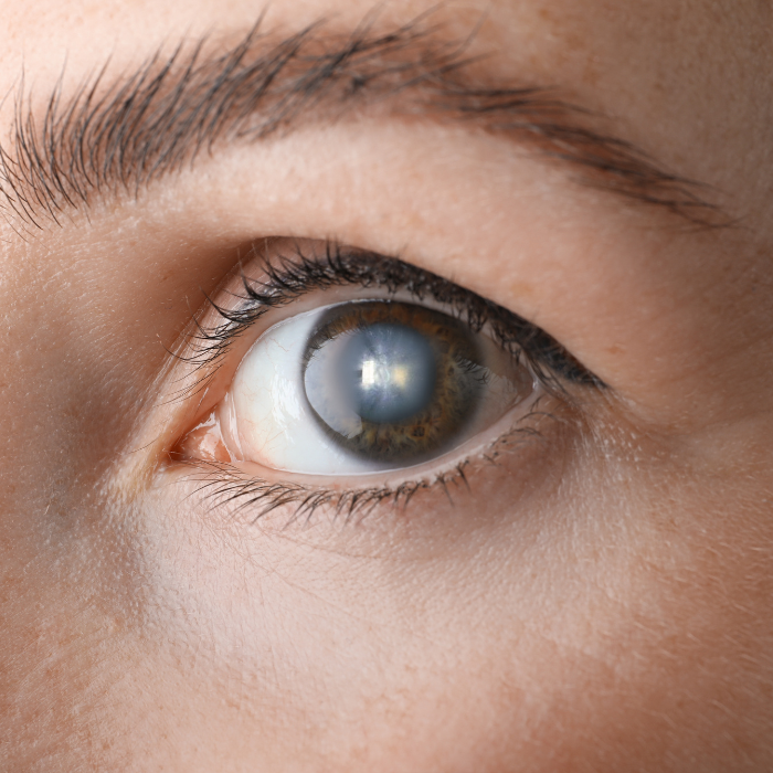 Chirurgia Del Glaucoma