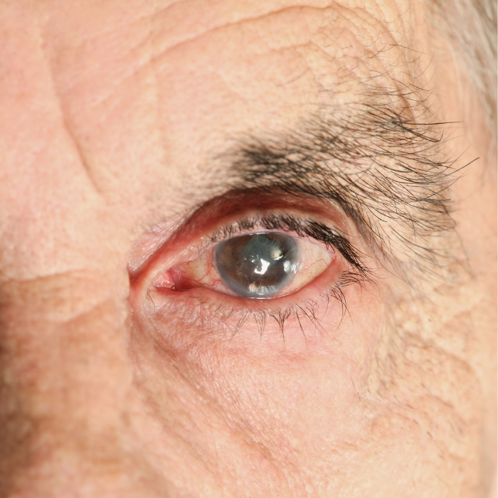 Screening & Prevenzione Glaucoma