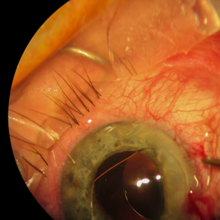 Chirurgia Del Glaucoma